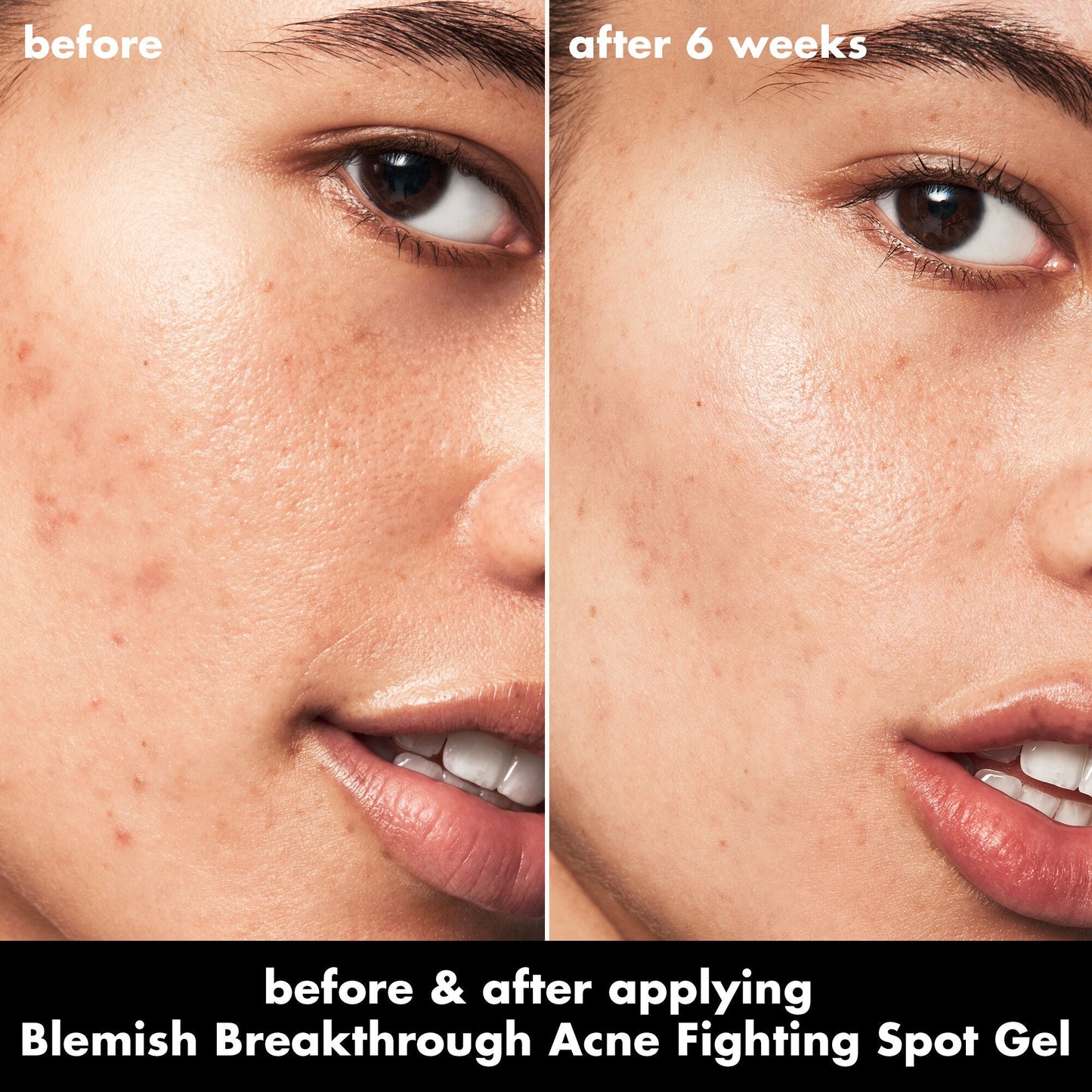 blemish-breakthrough-acne-fighting-spot-gel-x3 0326_EDU_BB_SpotGel_BA_ISABELLA.jpg