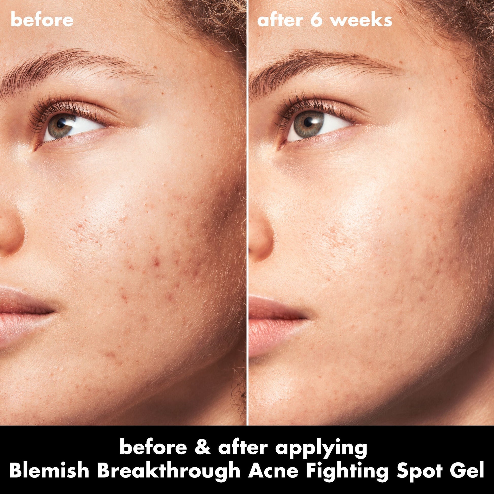 blemish-breakthrough-acne-fighting-spot-gel-x3 0326_EDU_BB_SpotGel_BA_MARLEY.jpg