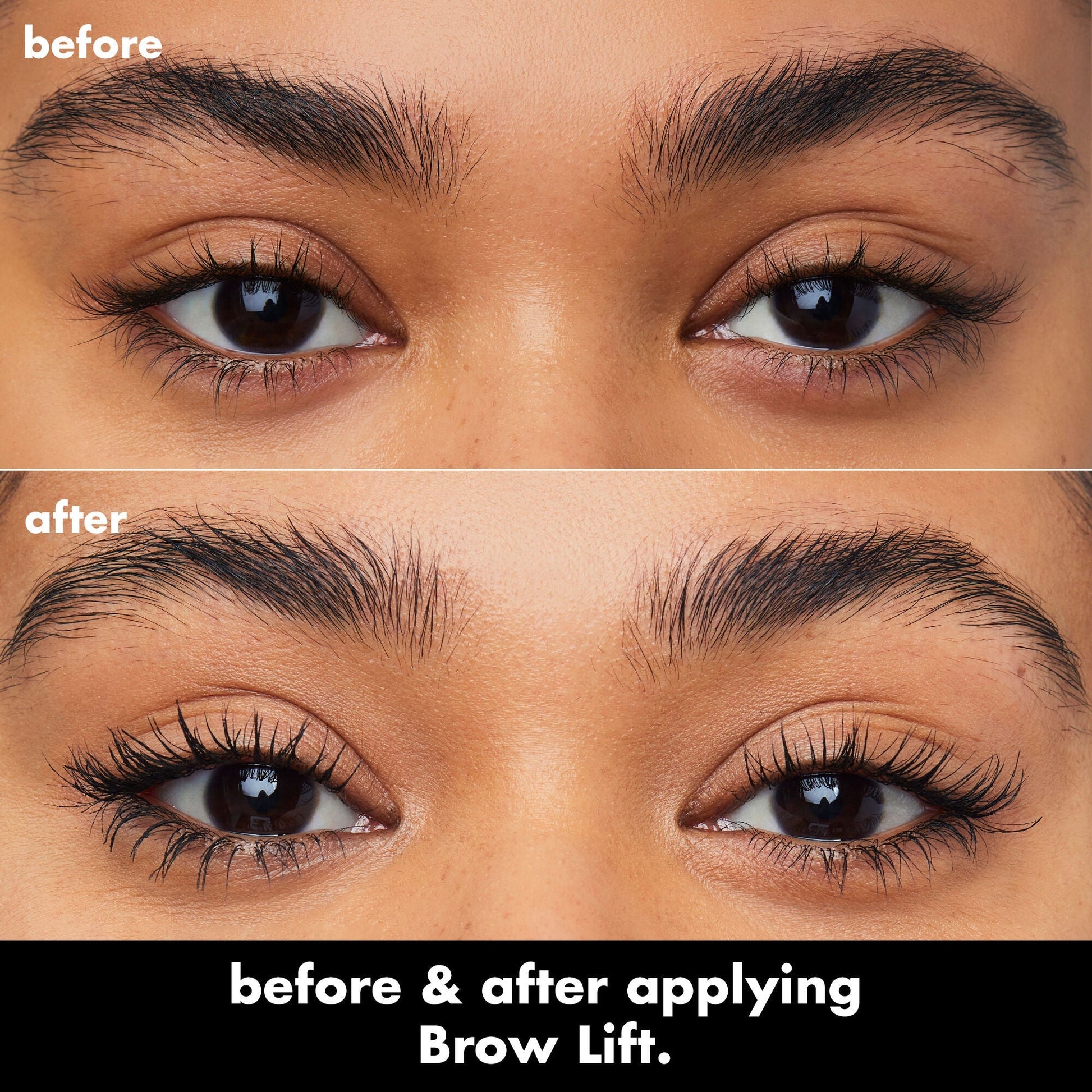 brow-lift-o5 0326_EDU_BrowLift_BA.jpg
