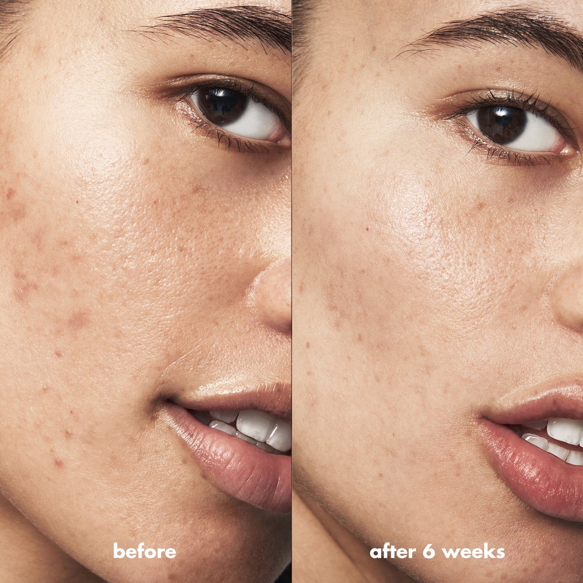 blemish-breakthrough-acne-clarifying-cleanser-l8 Acne_PDP_Isabella_Before_After_a3ff322b-cc6f-4b1a-9db3-bfb66c15d034.jpg