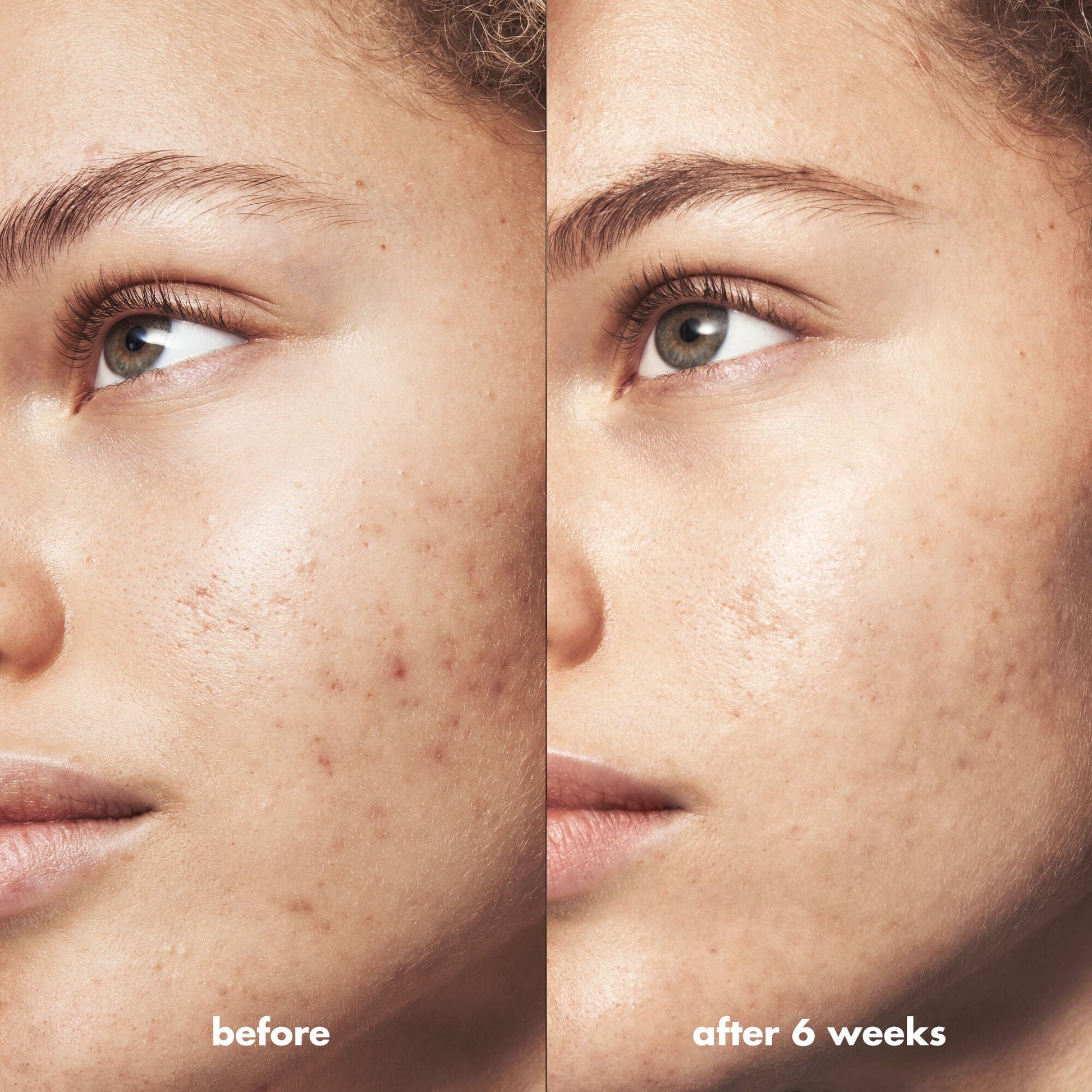 blemish-breakthrough-blemish-control-basics-kit-y7 Acne_PDP_Marley_Before_After_295728d2-6728-4f48-b8ef-c82bbca5b591.jpg
